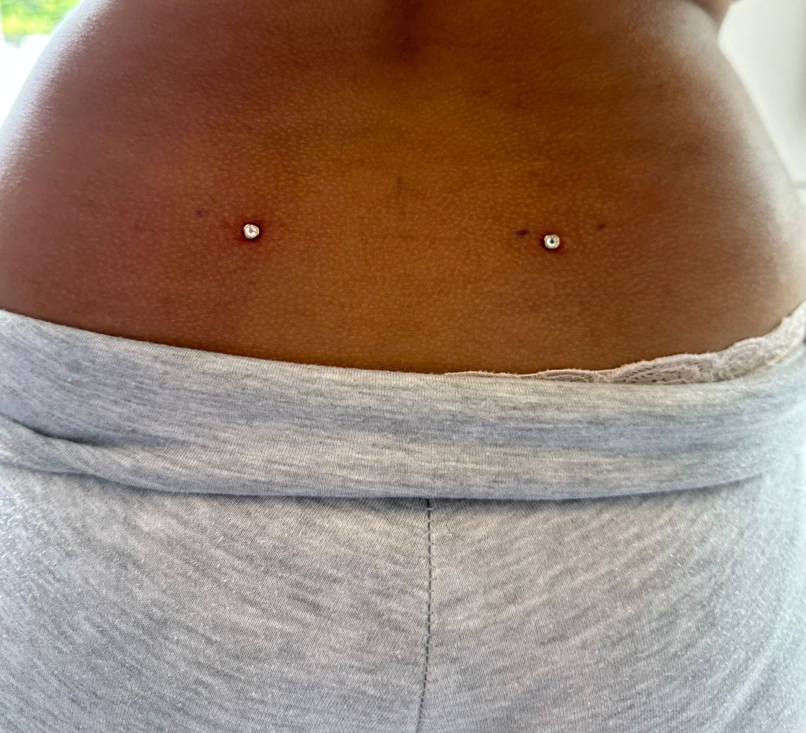 Microdermal